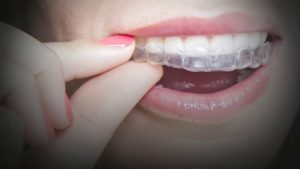 Bite Realignment: How It Impacts Your Teeth and Overall Health
