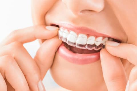 Reasons to Consider Getting Invisalign as an Adult