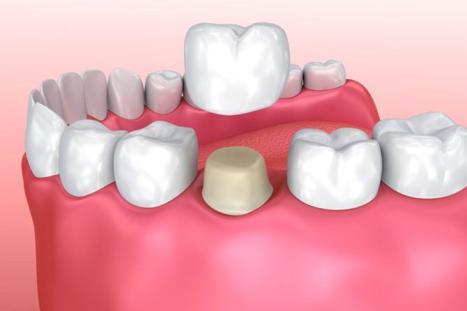 Top 10 Dental Crown FAQs