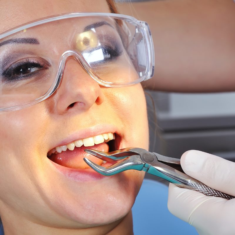 Tooth Extractions | Kherani Dental