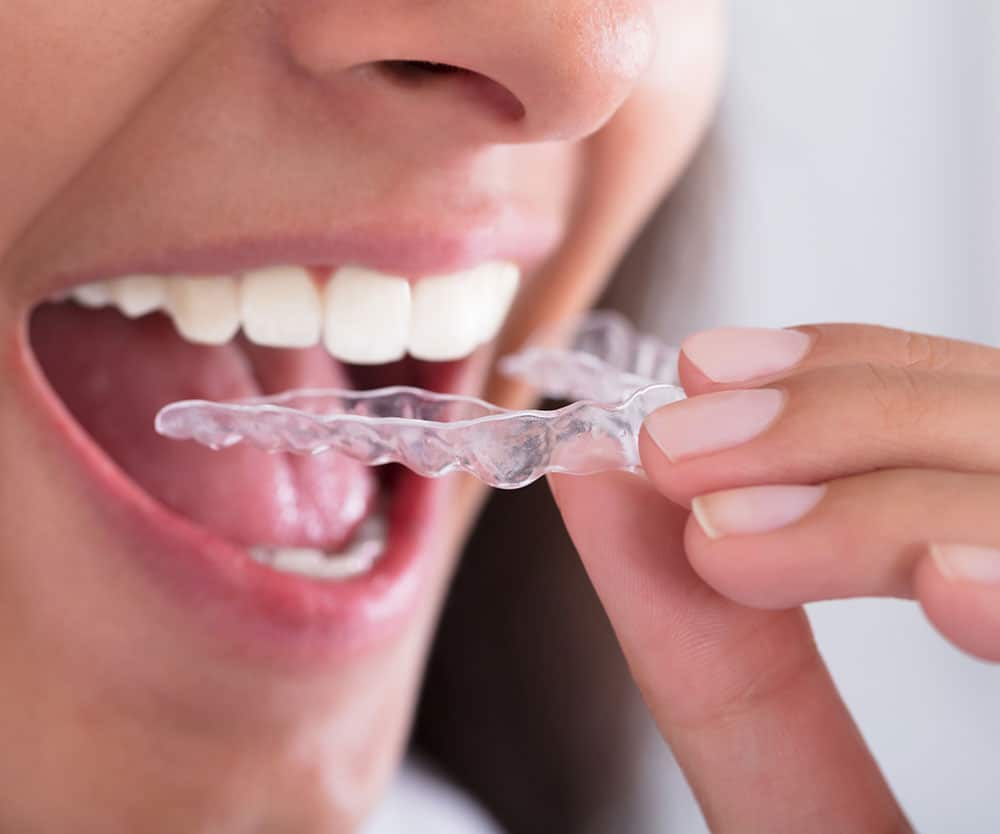 Which is Better, Braces or Invisalign?