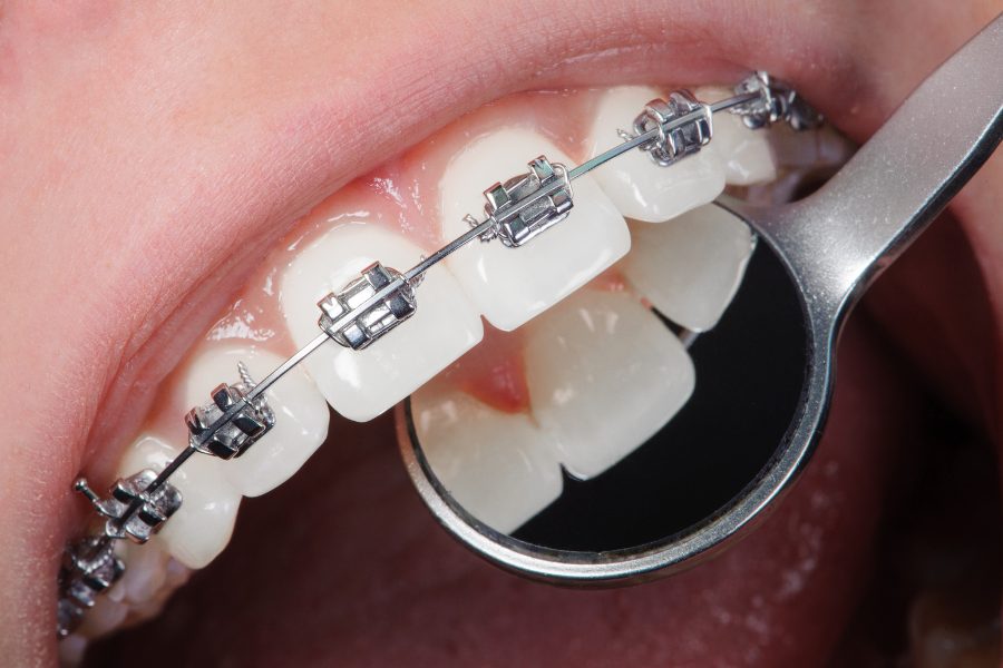 Orthodontic Treatment Kherani Dental at Aspen
